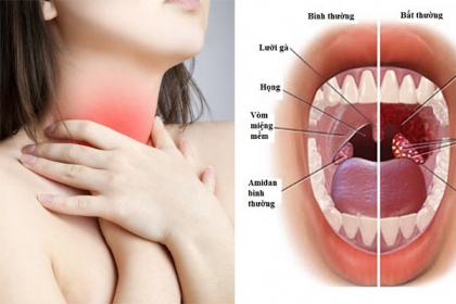 Cắt amidan ở người lớn trên 45 tuổi cần lưu ý những gì?