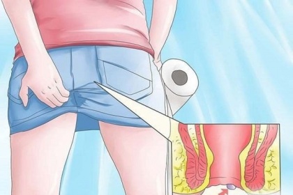Bệnh trĩ: Khi nào cần phẫu thuật?