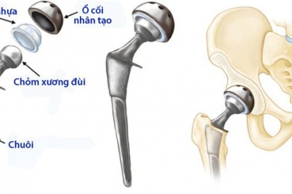 Biến chứng có thể gặp sau thay khớp háng nhân tạo