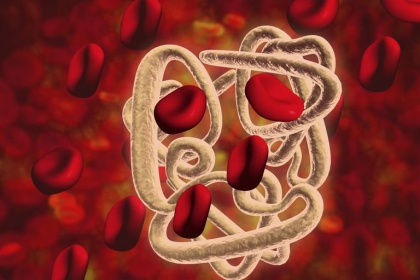 Làm thế nào để phát hiện bệnh thalassemia hay tan máu bẩm sinh ?