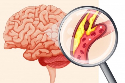 Sự hình thành cục máu đông trong tai biến mạch máu não