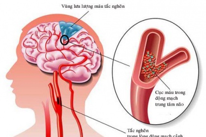 Thuốc tiêu sợi huyết Điều trị nhồi máu não