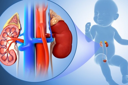 Viêm cầu thận cấp ở trẻ em là bệnh gì/ và Cách điều trị