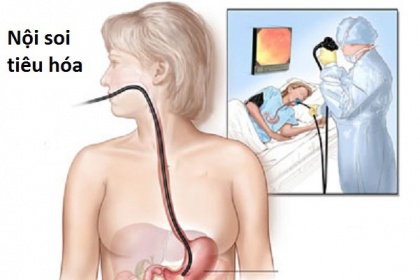 Nội soi tầm soát sau mổ ung thư đại trực tràng, tránh tái phát