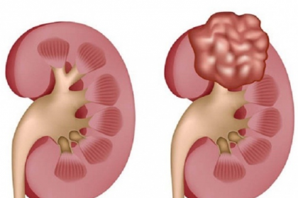 Phân biệt thận đa nang và nang thận