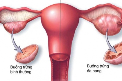U nang buồng trứng là bệnh gì? Liệu có thể trở thành ung thư buồng trứng?
