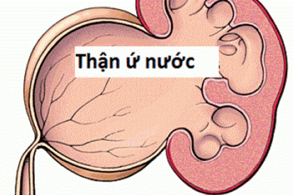 Thận ứ nước là bệnh gì?, Dấu hiệu, nguyên nhân và cách phòng ngừa