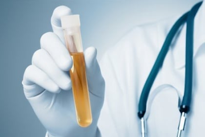 Ý nghĩa chỉ số SG trong xét nghiệm nước tiểu