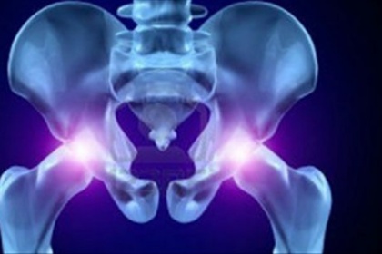 Thay lại khớp háng nhân tạo - Những điều cần biết