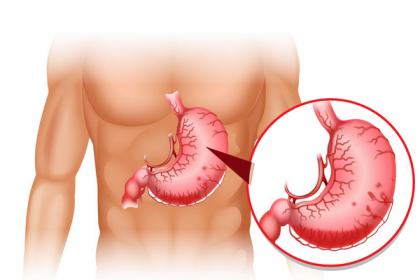 Hẹp môn vị: Biến chứng thường gặp ở bệnh loét dạ dày tá tràng mãn tính
