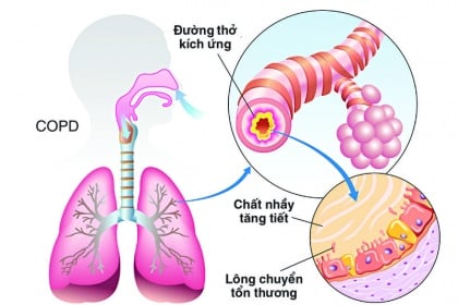 Bệnh phổi tắc nghẽn mãn tính có phải là hen suyễn do hút thuốc lá?