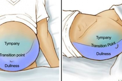 Tràn dịch màng bụng có nguy hiểm không?