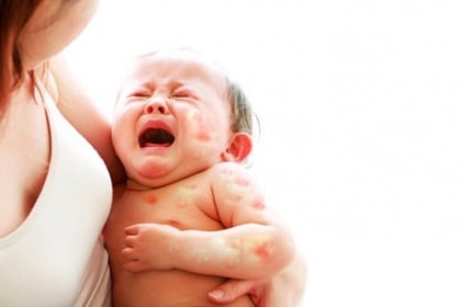 Trẻ bị dị ứng sữa là gì? - Nguyên nhân, dấu hiệu nhận biết và cách xử lý