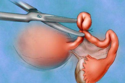 Phẫu thuật cắt tử cung - Những điều cần biết