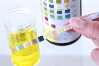 Ý nghĩa Chỉ số PH trong xét nghiệm nước tiểu