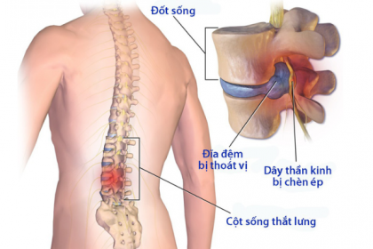 Đốt sống thắt lưng: Đặc điểm, chức năng và Các bệnh thường gặp