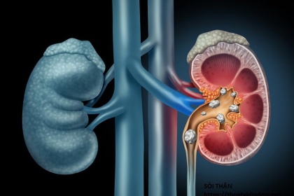 Bị sỏi thận đau ở đâu?, có đau nhiều không?