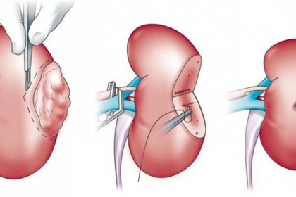 Trường hợp nào phải Cắt thận bán phần?