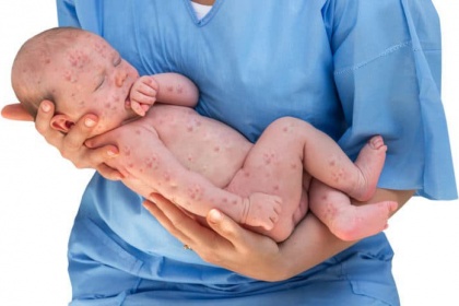 Cách phòng ngừa Hội chứng rubella bẩm sinh