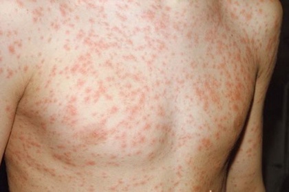 Rubella bẩm sinh là bệnh gì? Chẩn đoán và điều trị