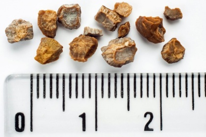 Sỏi thận 6-7mm có nguy hiểm không? nên uống thuốc hay nên phẫu thuật?