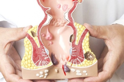 Bệnh trĩ là bệnh gì? Triệu chứng và Cách điều trị