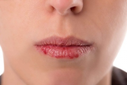 Triệu chứng khô miệng khi xạ trị ung thư đầu cổ bệnh nhân cần biết