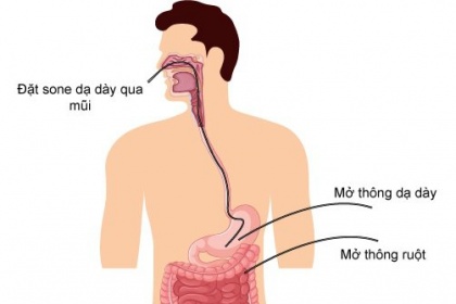 Mở thông dạ dày nuôi dưỡng bệnh nhân ung thư thực quản