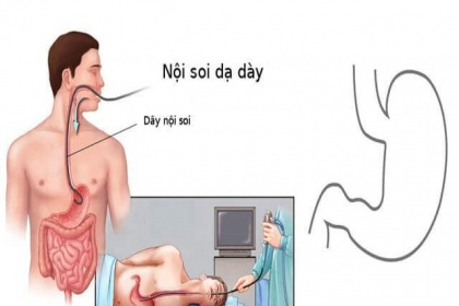 Nội soi dạ dày gây mê cần chuẩn bị thế nào?