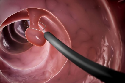 Nội soi cắt polyp ống tiêu hóa > 1cm hoặc đa polyp