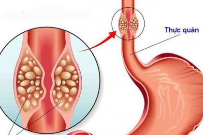 Ung thư thực quản: Nguyên nhân, triệu chứng, tiên lượng bệnh và cách điều trị