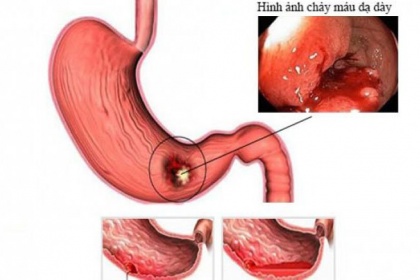 Kỹ thuật xạ hình chẩn đoán chảy máu dạ dày, ruột (xuất huyết đường tiêu hóa) ở trẻ em