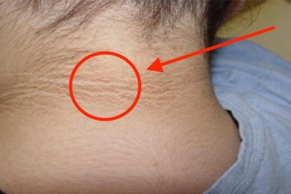 Bệnh gai đen (acanthosis nigricans) có nguy hiểm không?