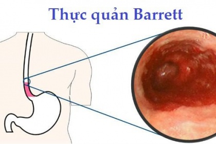 Các phương pháp điều trị bệnh Barrett thực quản