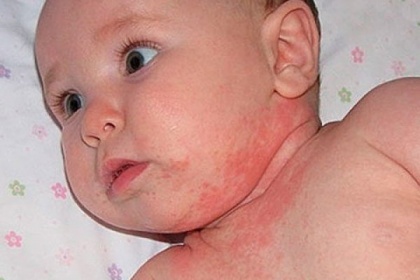 Sử dụng corticoid ở trẻ em những điều cần biết