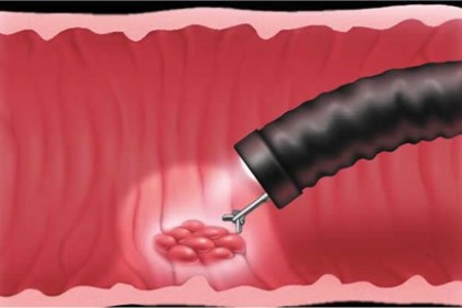 Những điều cần biết về sinh thiết dạ dày