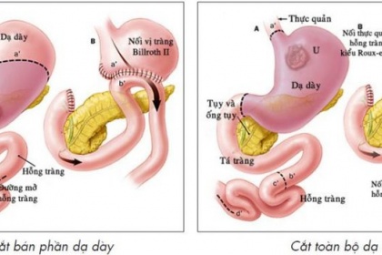 Cắt dạ dày được chỉ định trong trường hợp nào?