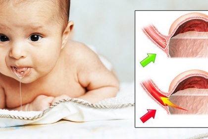 Đặt ống thông dạ dày cho trẻ sơ sinh: Những điều cần biết