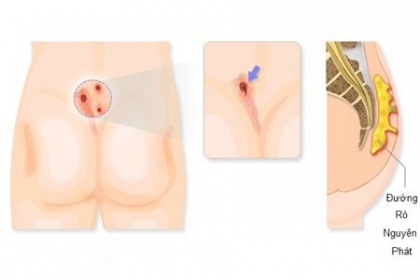 Nguyên nhân lỗ rò hậu môn và Cách điều trị