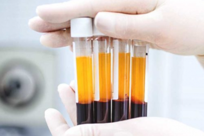 Tìm hiểu nghiệm pháp rượu ethanol