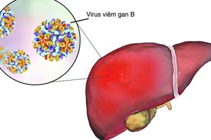 Điều trị bệnh viêm gan B theo từng trường hợp cụ thể