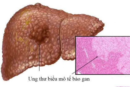 Ung thư biểu mô tế bào gan là gì? Triệu chứng, Chẩn đoán và Điều trị