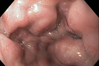 Hình ảnh nội soi giãn tĩnh mạch thực quản