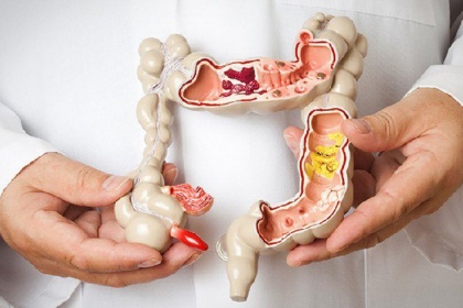 Nang ruột đôi là bệnh gì? và Cách điều trị