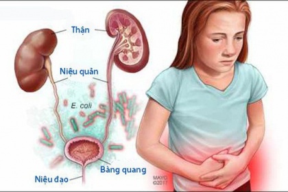 Nhiễm khuẩn tiết niệu ở trẻ em: Nguyên nhân, dấu hiệu, điều trị