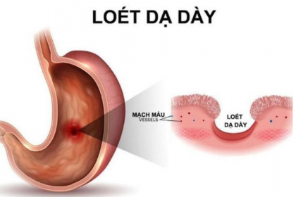 Các thể lâm sàng và loét dạ dày tá tràng