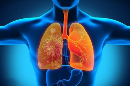 Những điều cần biết về bệnh viêm phổi hít