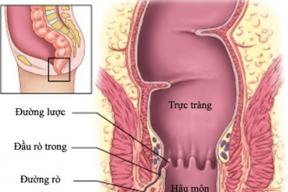 Rò hậu môn tiền đình ở trẻ sơ sinh