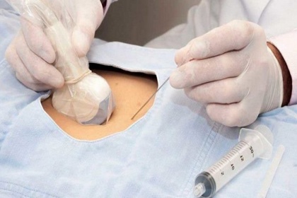 Chọc ối là gì? Thai phụ mắc viêm gan B có nên chọc ối không?