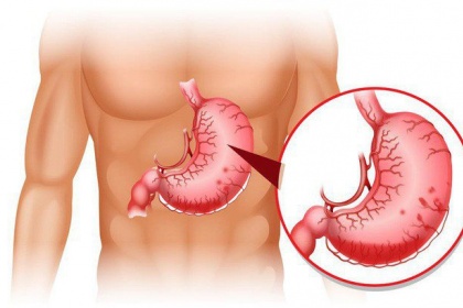 Đau dạ dày ở vị trí nào?